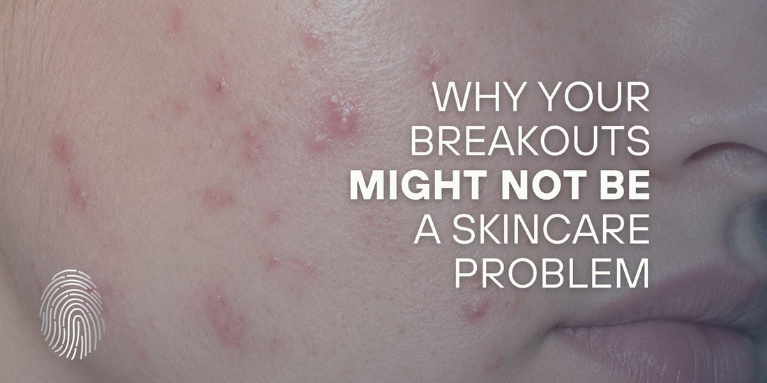 Why Your Breakouts Might Not Be a Skincare Problem
