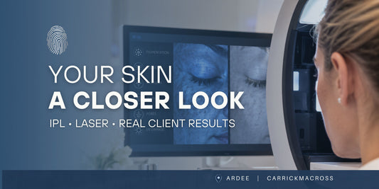 Touch & Glow IPL and laser skin treatments blog cover featuring skin analysis imagery and information about pigmentation, facial veins and real client results.