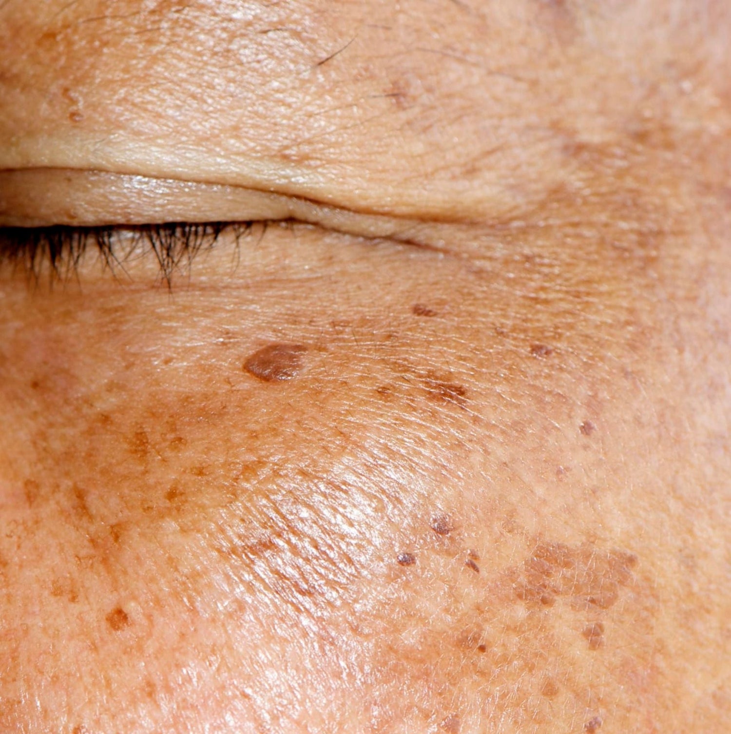 CONCERN - PIGMENTATION