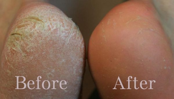 Callus Peel - Touch & Glow Beauty