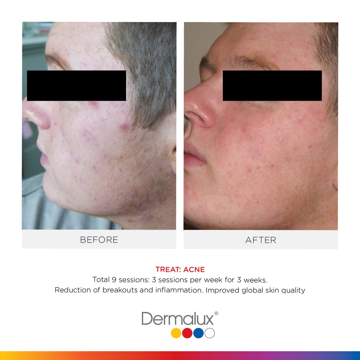 Dermalux-SM-Before-After004 Dermalux - Touch & Glow Skin And Laser Clinic