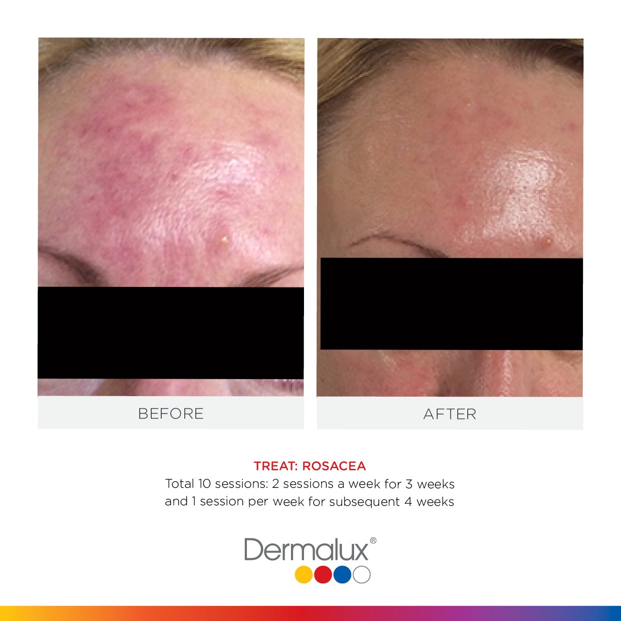 Dermalux – Touch & Glow Skin And Laser Clinic Dermalux - Touch & Glow Skin And Laser Clinic