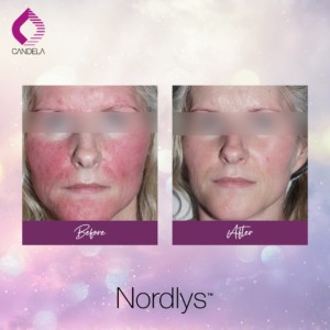 Laser Pigmentation Removal - Touch & Glow Skin And Laser